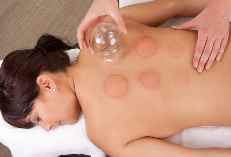 Cupping therapy treatment in Stirling